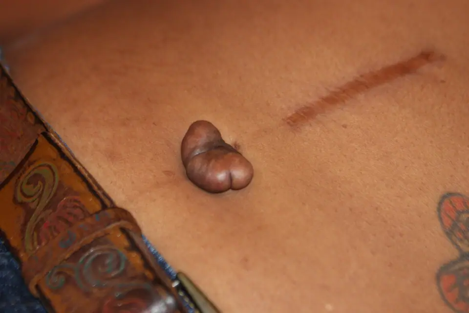 Bulto de queloide alrededor de un piercing de ombligo