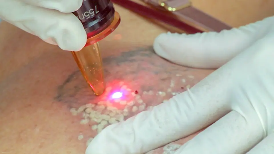 Primer plano de una sesión de eliminación de tatuaje con láser