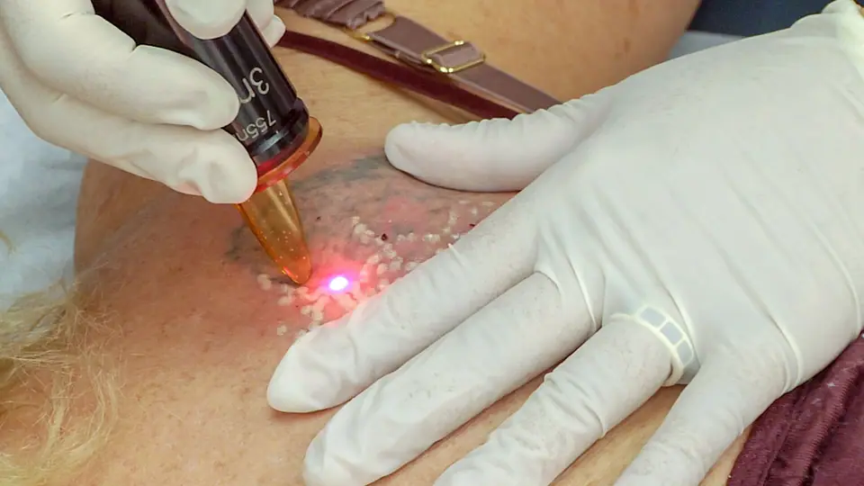 Aplicación de láser sobre un tatuaje durante una sesión de eliminación