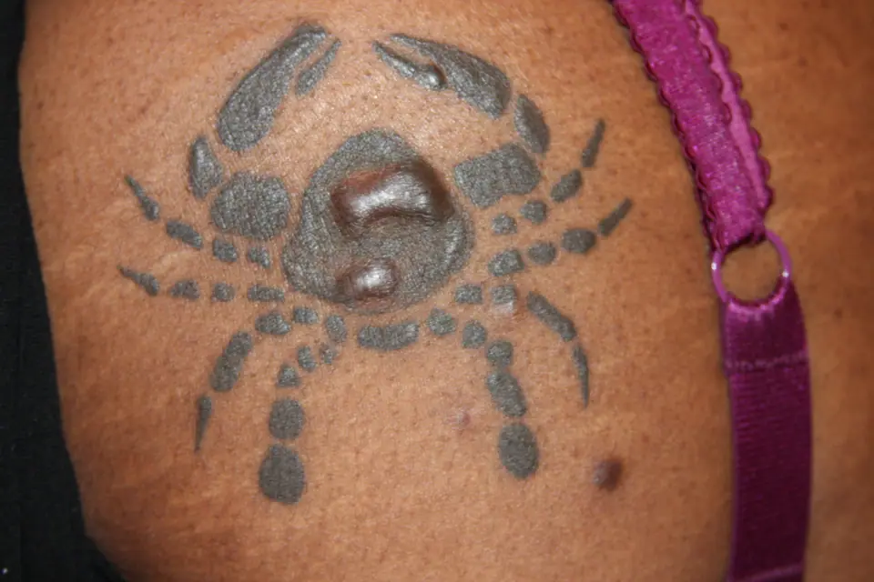 Tatuaje de cangrejo en el hombro con un queloide (bulto de piel elevado) junto al diseño